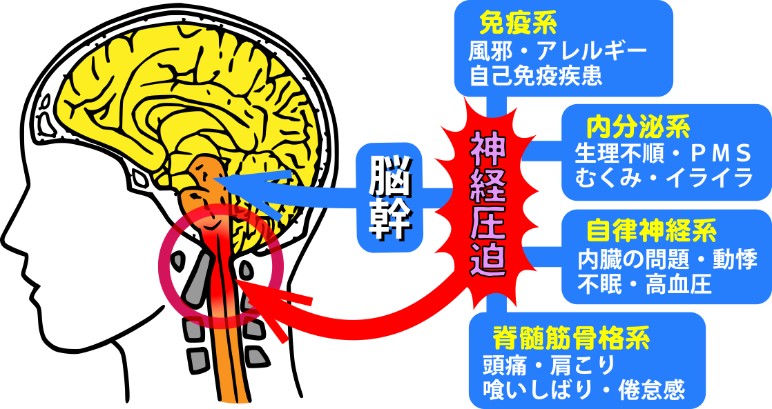 脳幹圧迫による症状　大阪堺市YELL（図）