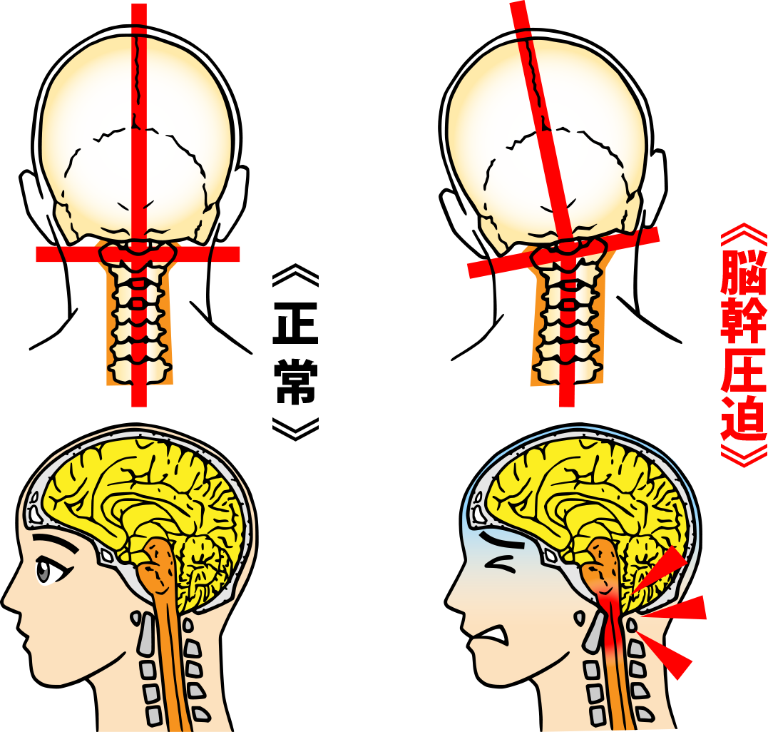 脳幹　身体の歪み　大阪堺市YELL（図）