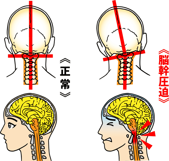 大阪堺市 バランス整体院エール　脳幹圧迫