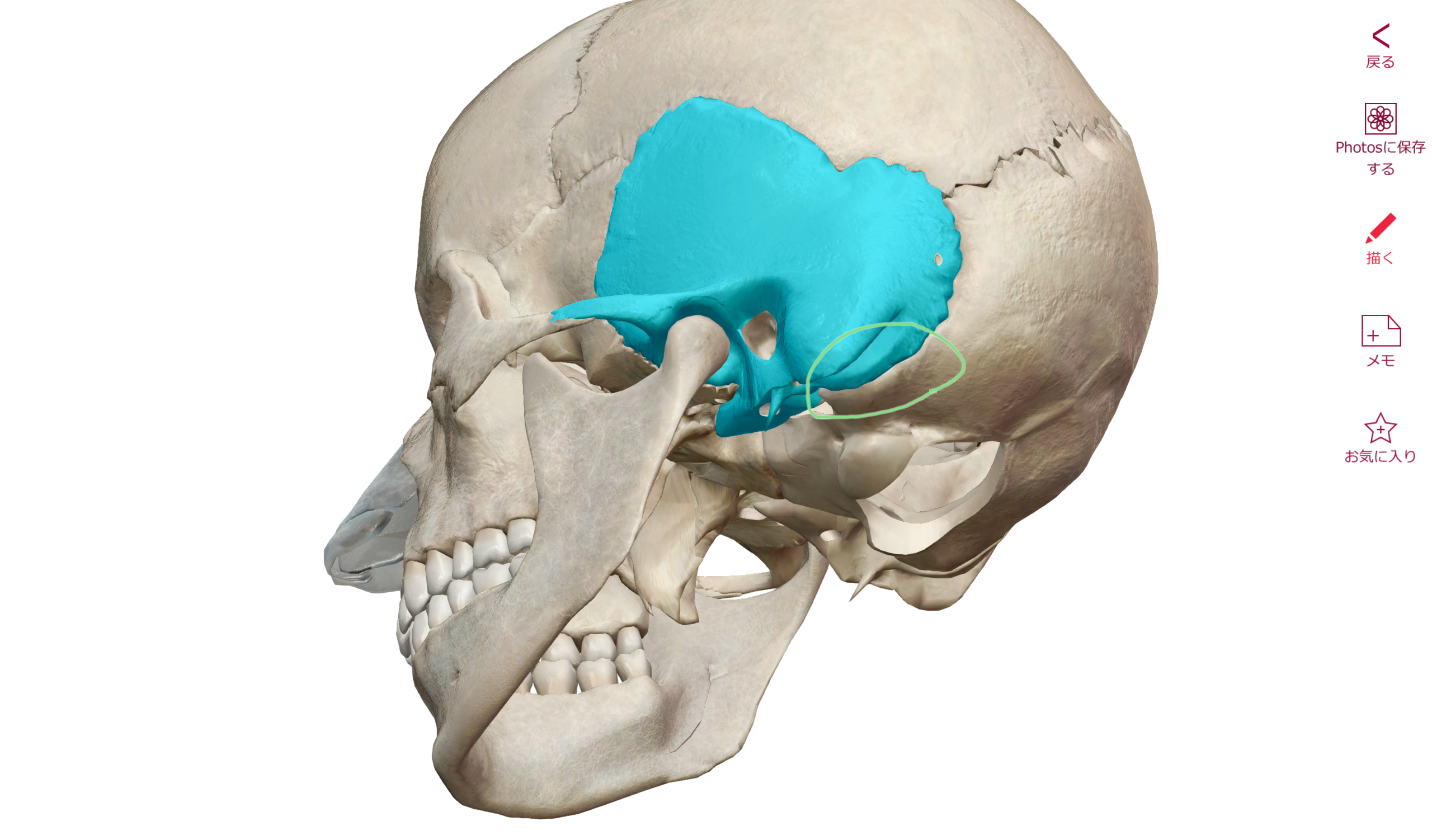 側頭骨と片頭痛